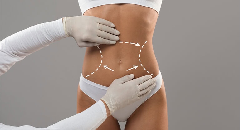 Laser (Smartlipo) Liposuction in Turkey