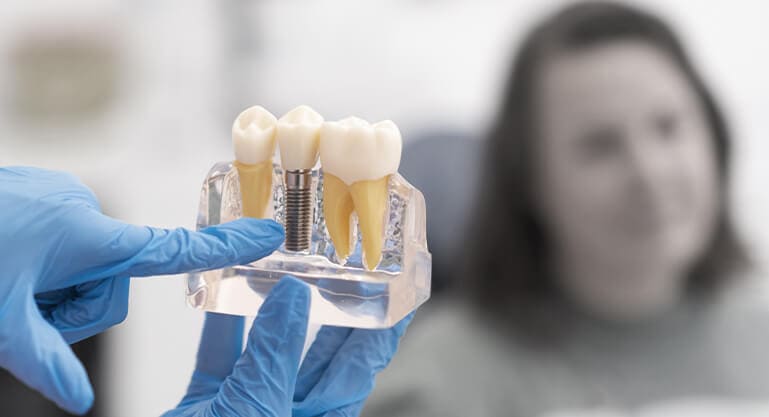 Stabilizzazione delle protesi dentarie