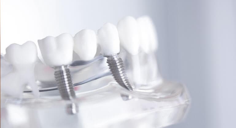 Subperiosteal Implant