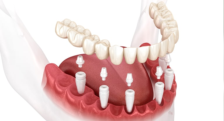 Subperiosteal Implant