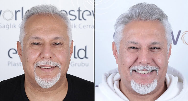 Türkei Haartransplantation Ergebnisse: Vorher & Nachher - Esteworld