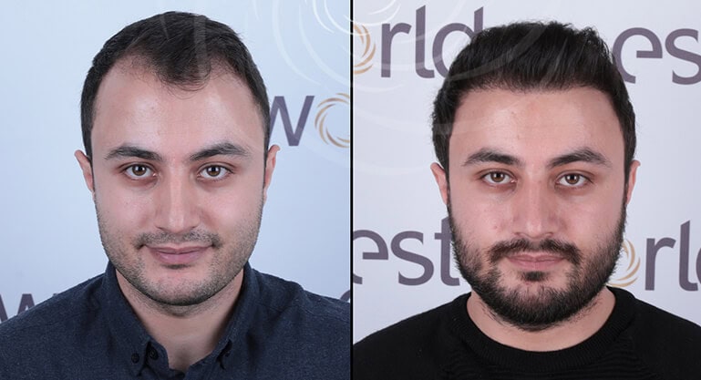 Türkei Haartransplantation Ergebnisse: Vorher & Nachher - Esteworld