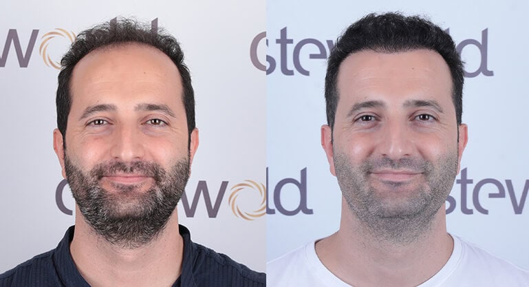 Türkei Haartransplantation Ergebnisse: Vorher & Nachher - Esteworld