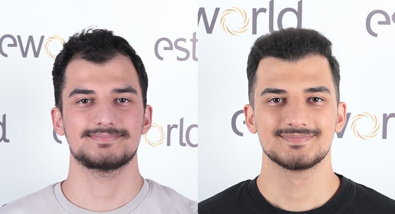 Türkei Haartransplantation Ergebnisse: Vorher & Nachher - Esteworld