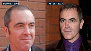 Celebrity Hair Transplant Cases in Turkey Celebrity Hair Transplant Cases in Turkey