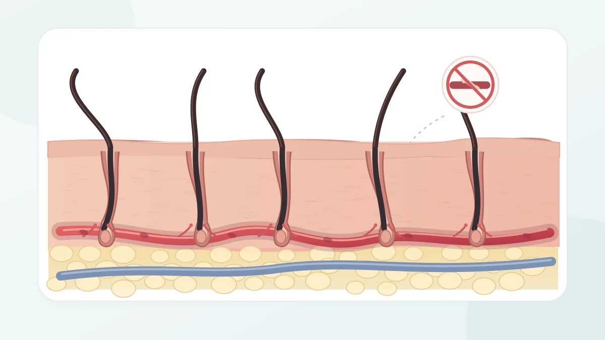 The Impact of Smoking and Alcohol on Hair Transplant Success Medical illustration of scalp hair follicles and blood vessels highlighting the importance of circulation during hair transplant healing.