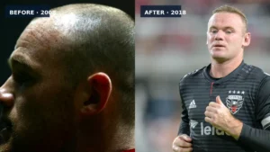 Celebrity Hair Transplant Cases in Turkey Celebrity Hair Transplant Cases in Turkey