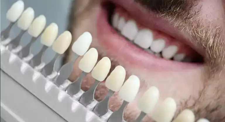 dental veneers in turkey