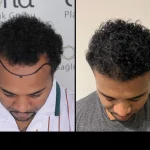 Afro Hair Transplant in Turkey