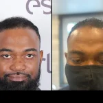 Afro Hair Transplant in Turkey