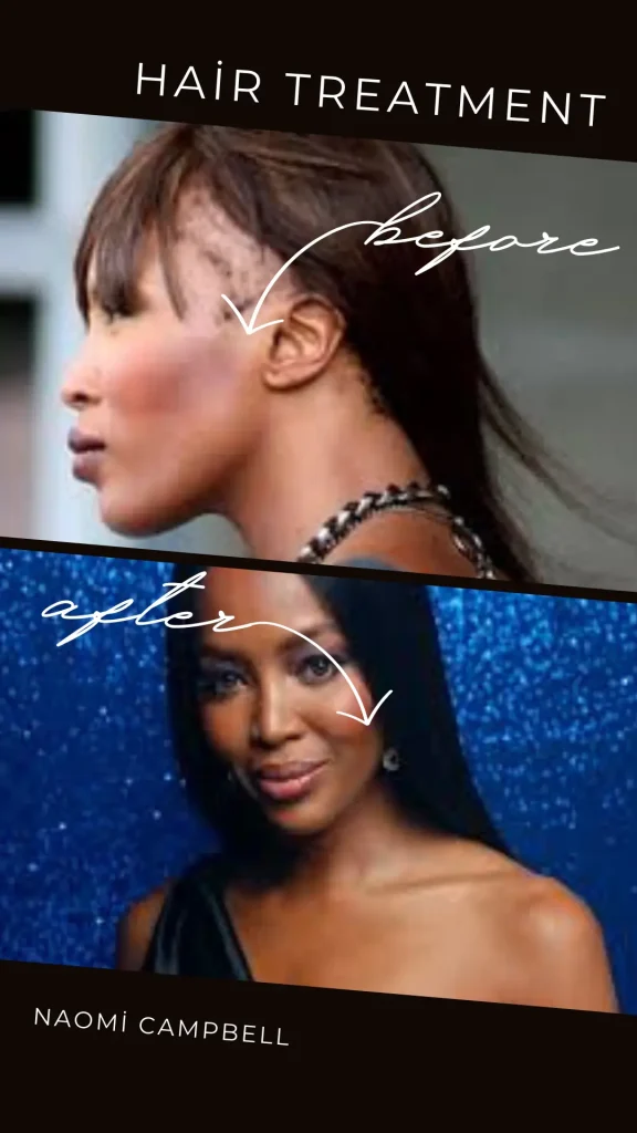 What famous woman has a hair transplant?