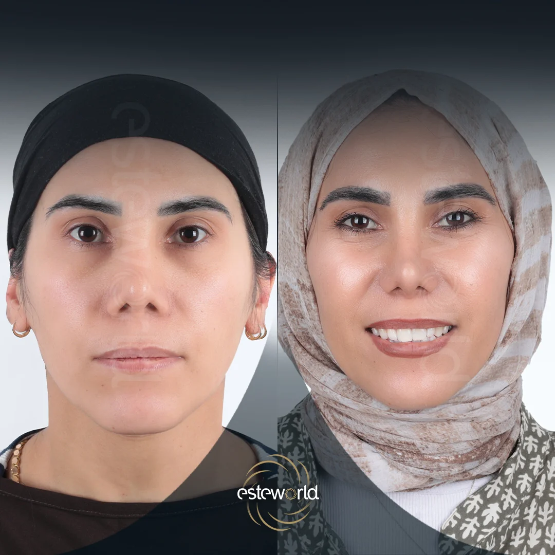 eyebrow-before-after11