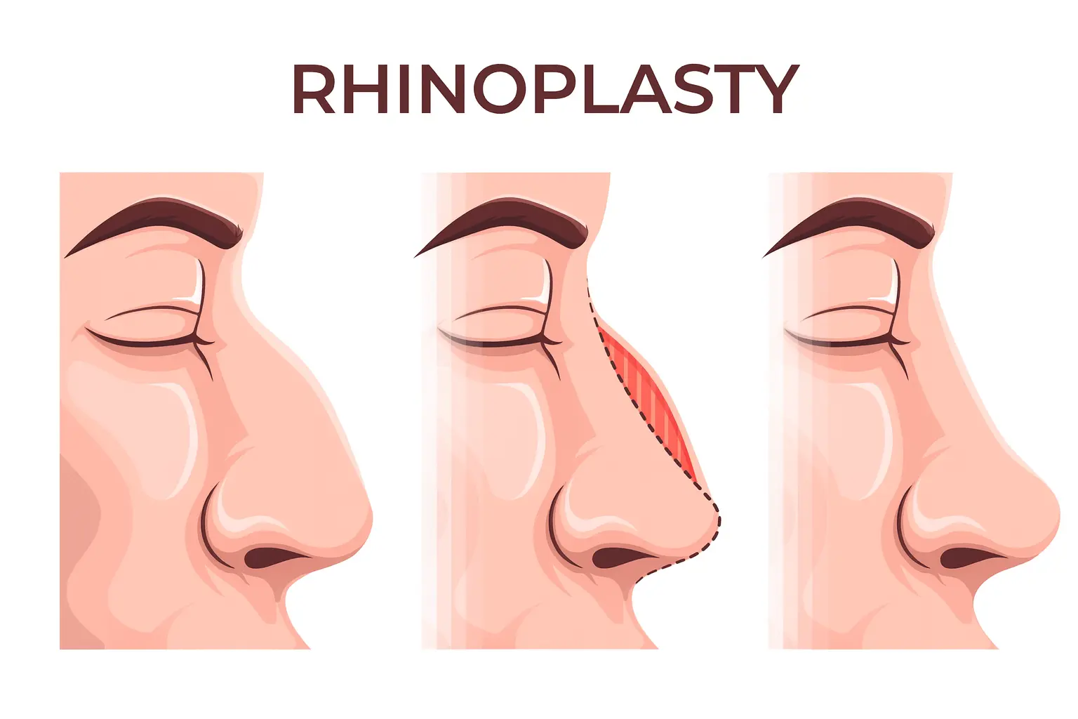 How Should Male Rhinoplasty Be Performed? How Should Male Rhinoplasty Be Performed?