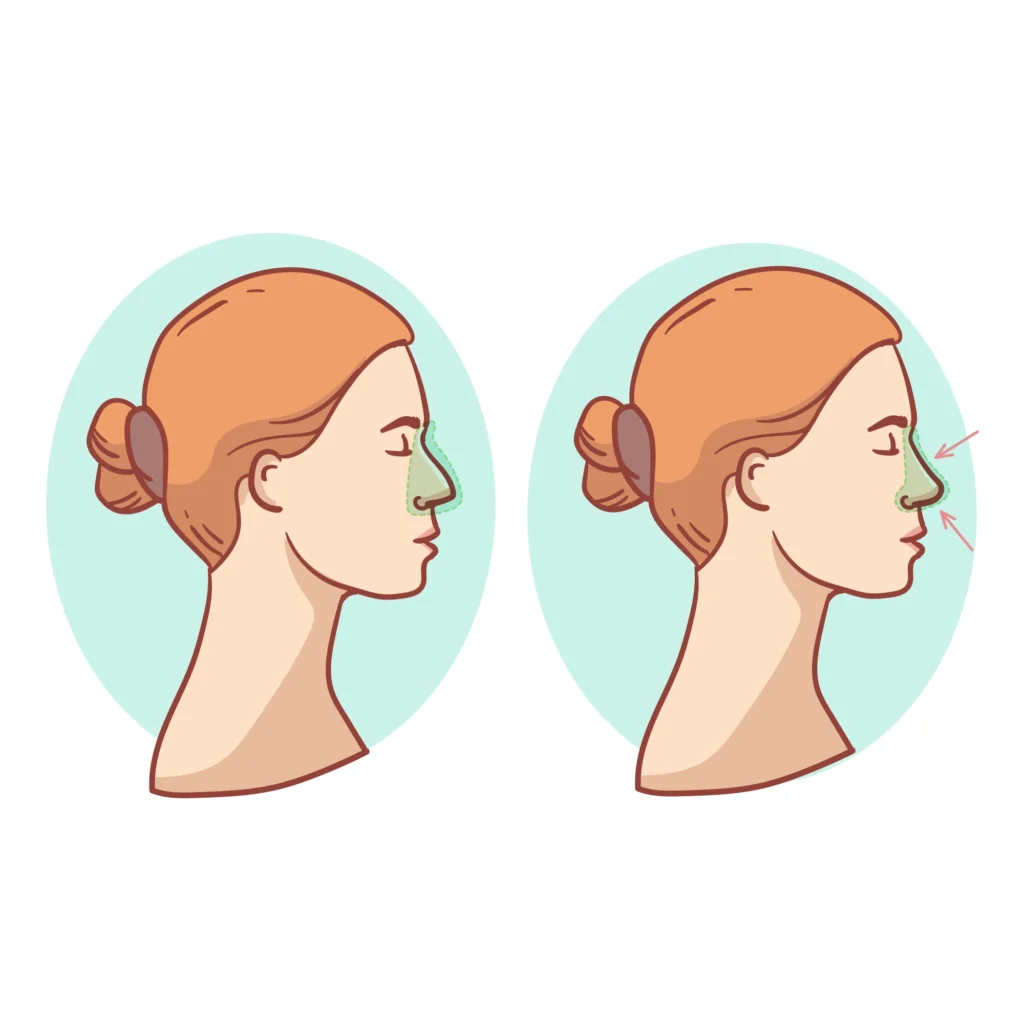 How to Reduce Swelling, Bruising, and Edema After Rhinoplasty How to Reduce Swelling, Bruising, and Edema After Rhinoplasty