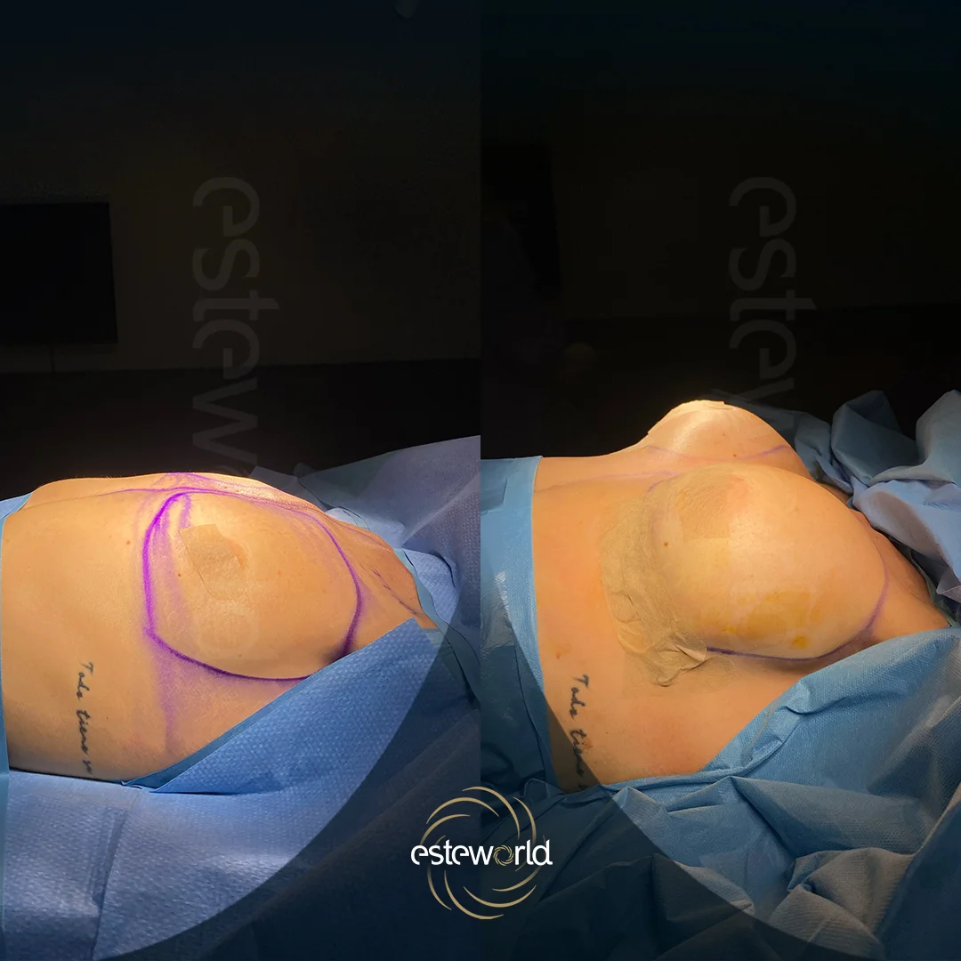 breast-before-after0