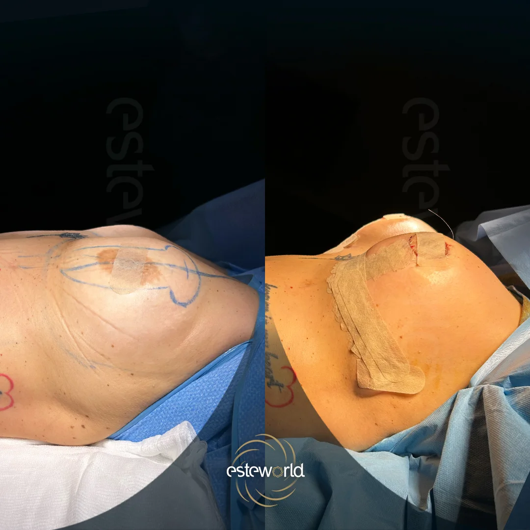 breast-before-after1