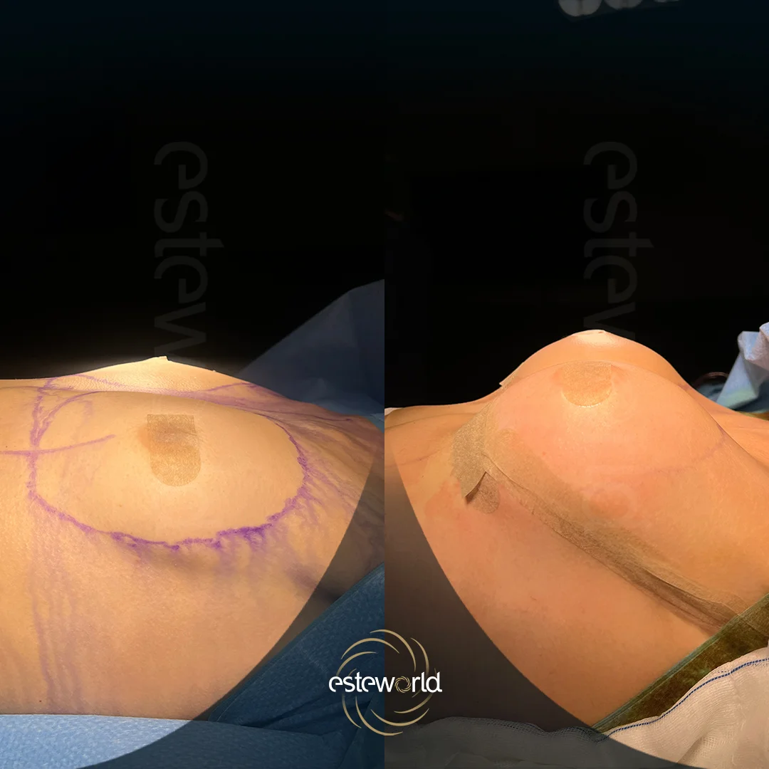 breast-before-after12