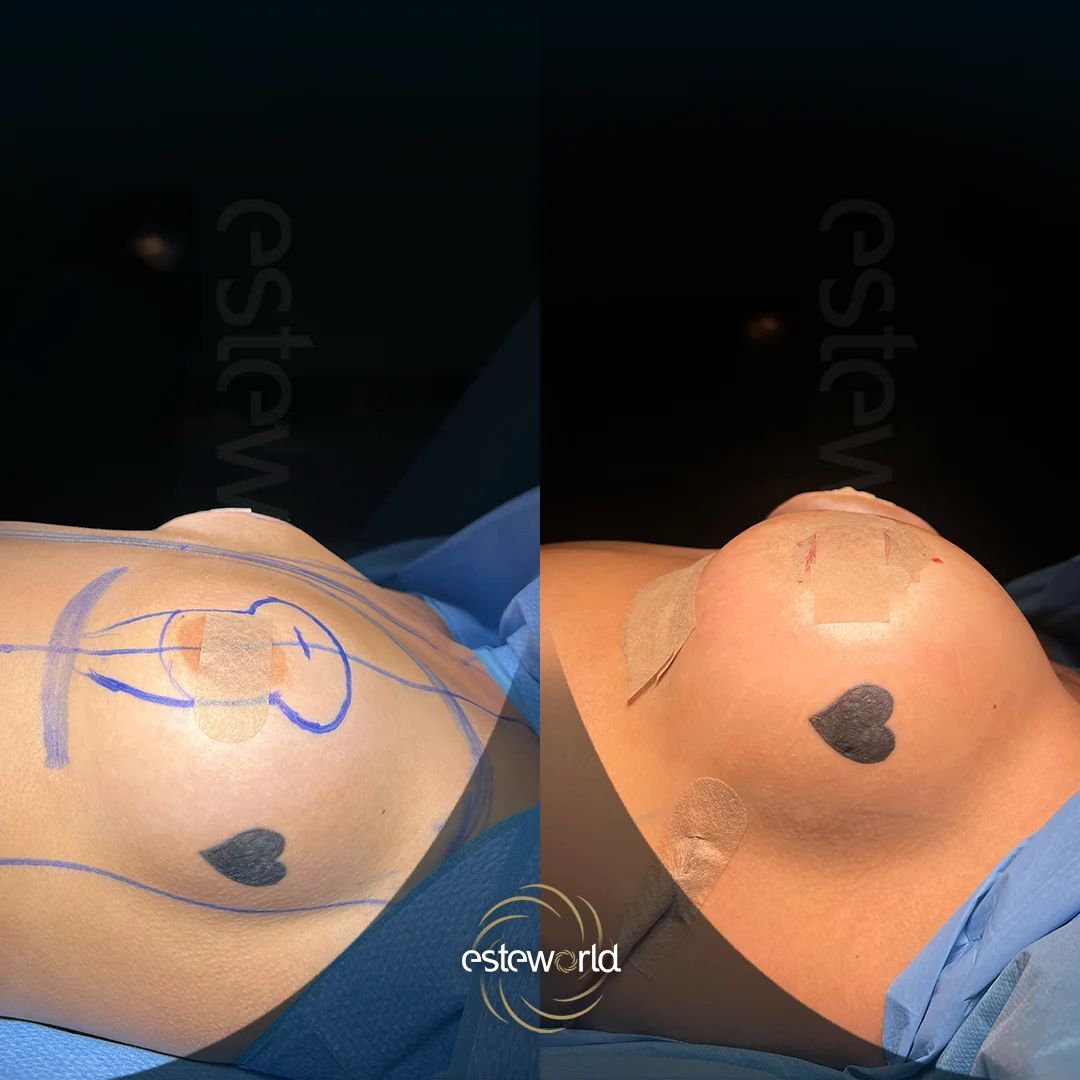 breast-before-after5