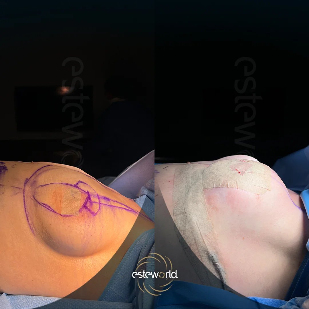 breast-before-after6