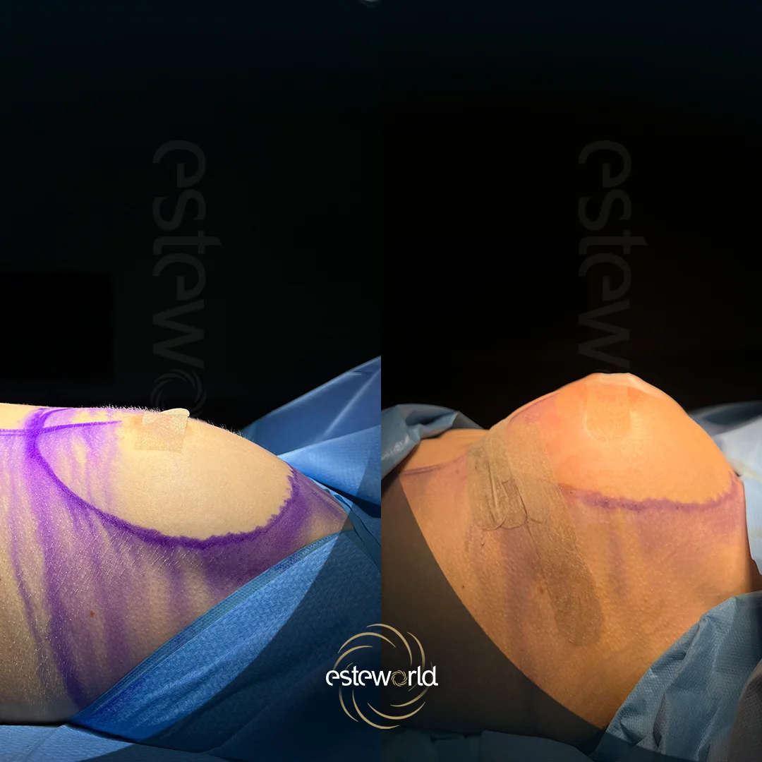 breast-before-after7