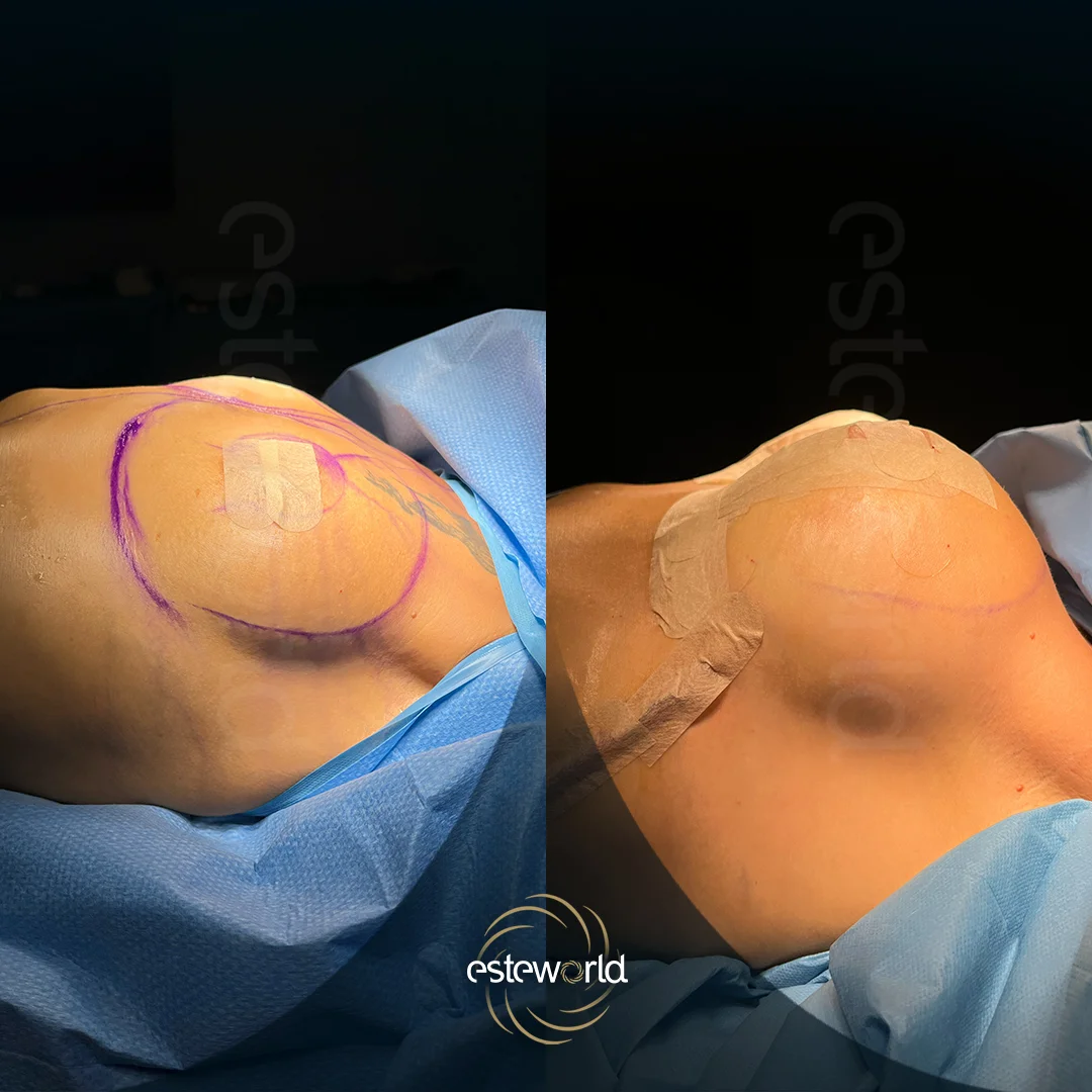 breast-before-after8