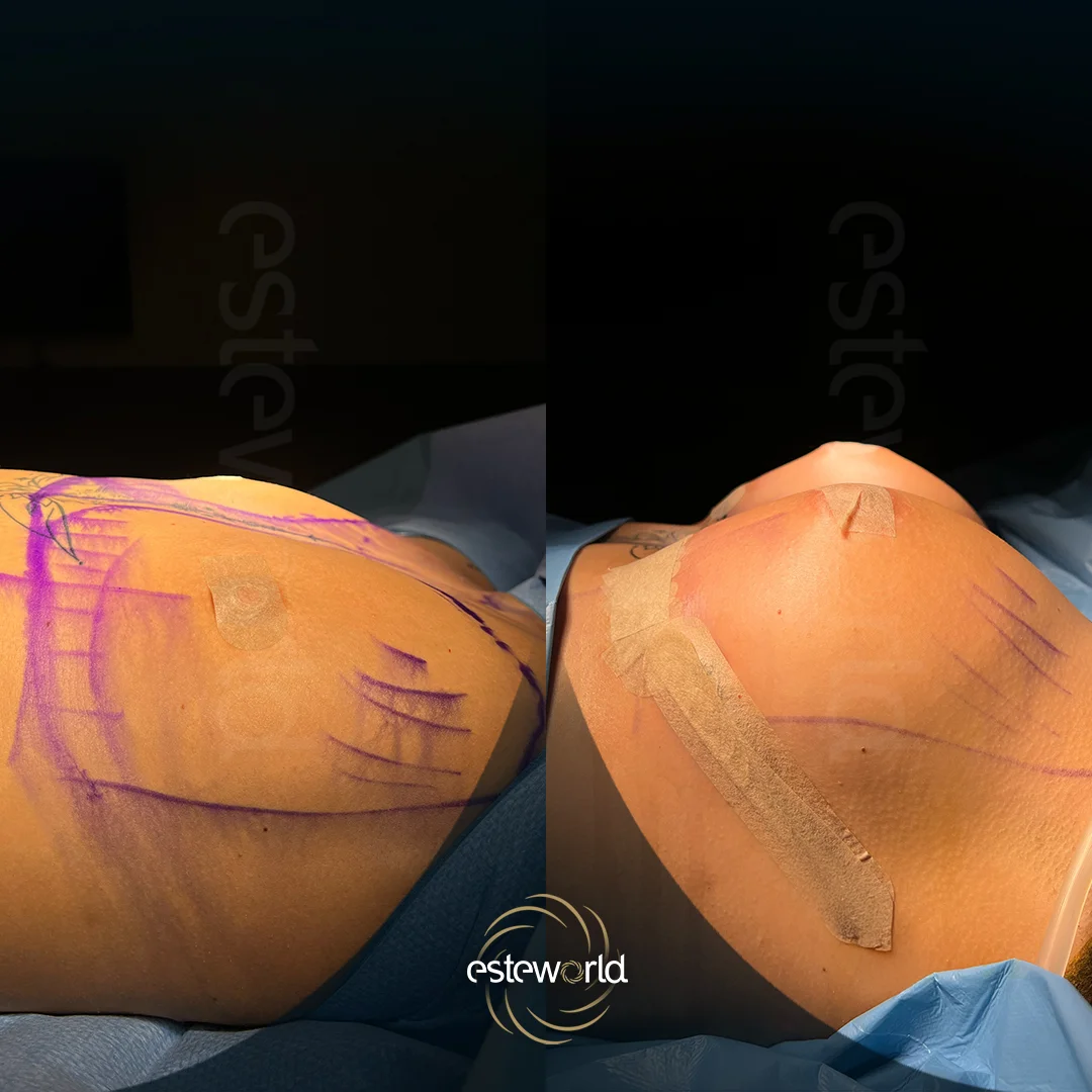 breast-before-after9