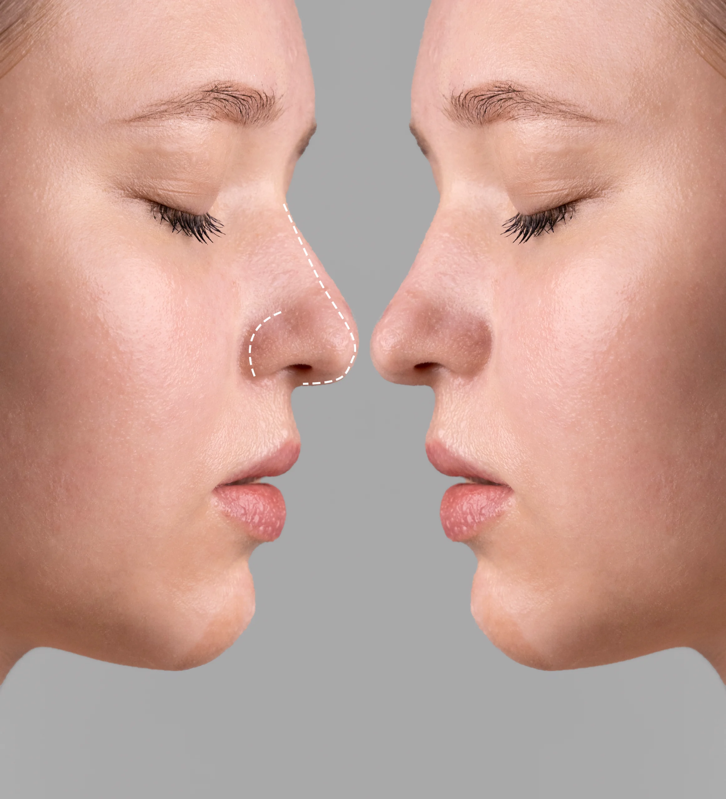 Is Revision Rhinoplasty Difficult?