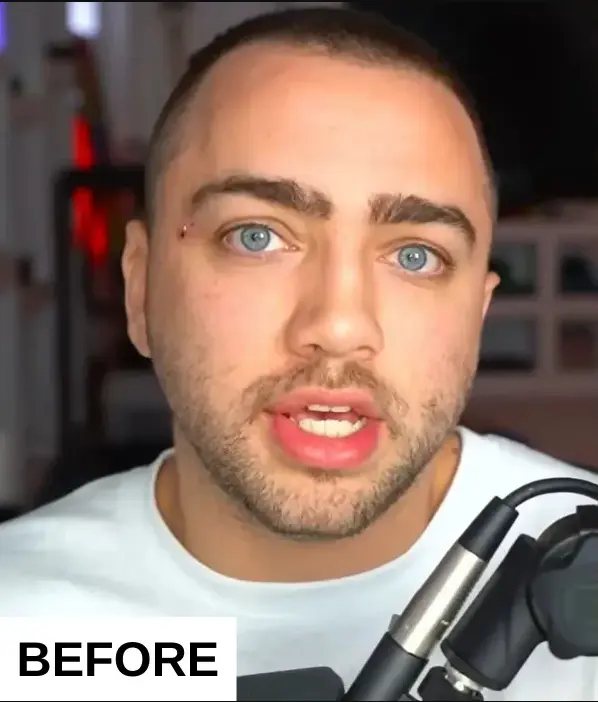 Mizkif (Matthew Rinaudo) Hair Transplant Mizkif (Matthew Rinaudo) Hair Transplant