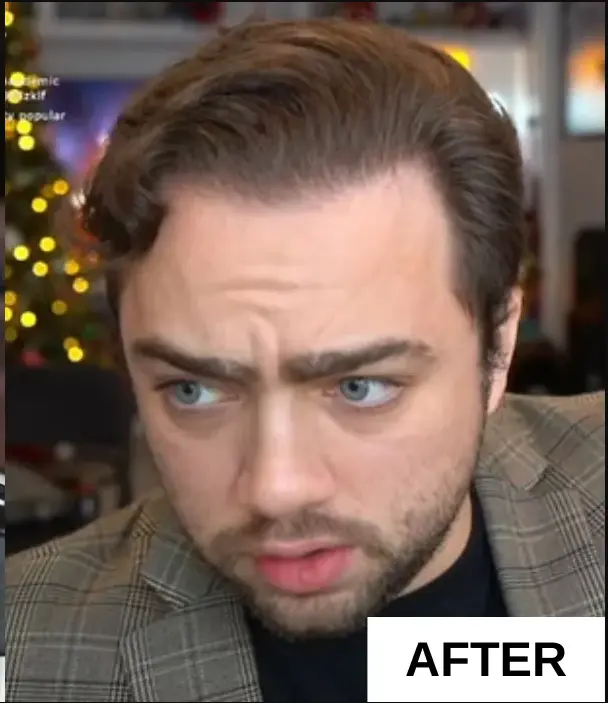 Mizkif (Matthew Rinaudo) Hair Transplant Mizkif (Matthew Rinaudo) Hair Transplant