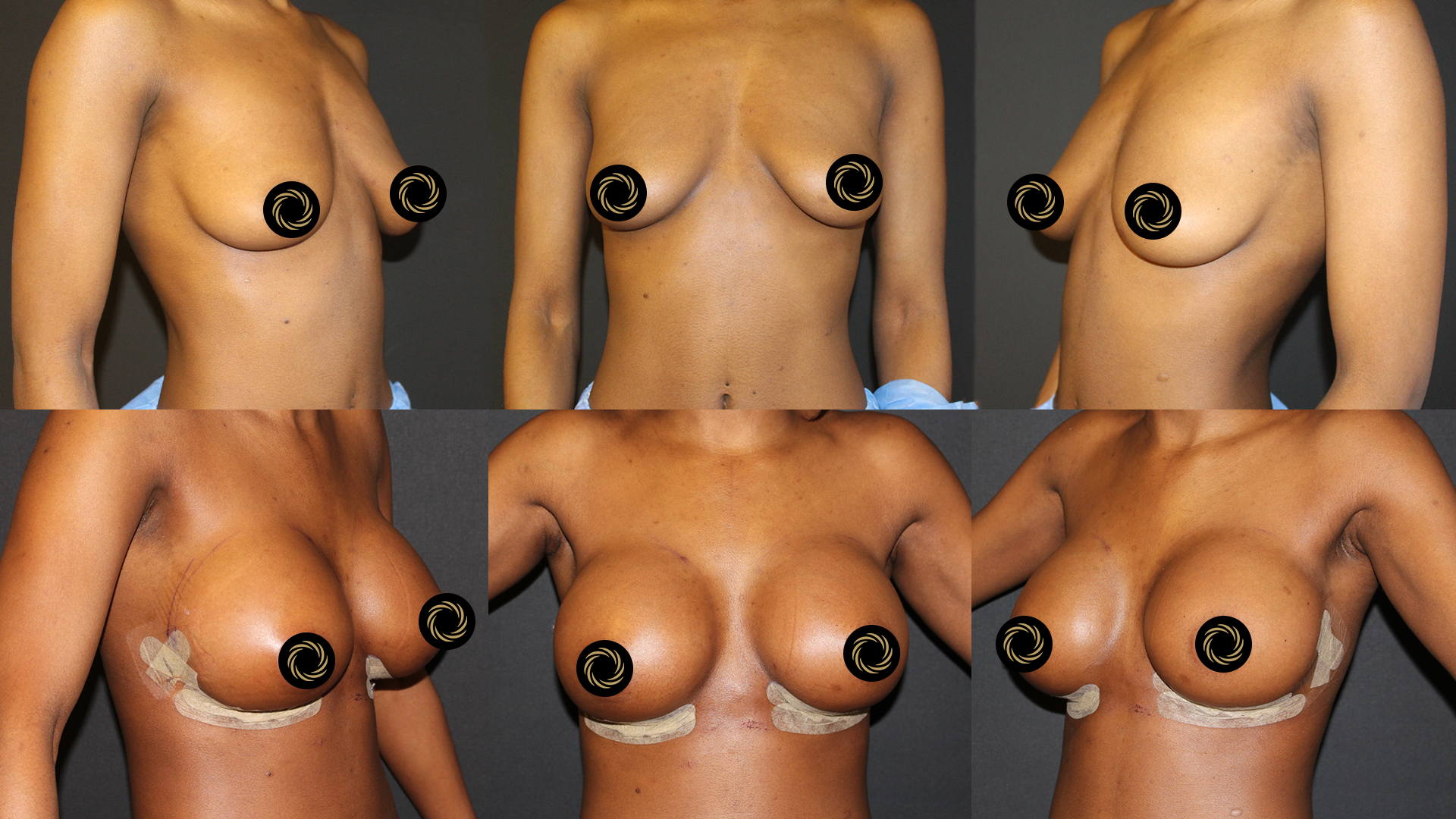Breast Lift (Mastopexy) in Turkey breast-before-after1