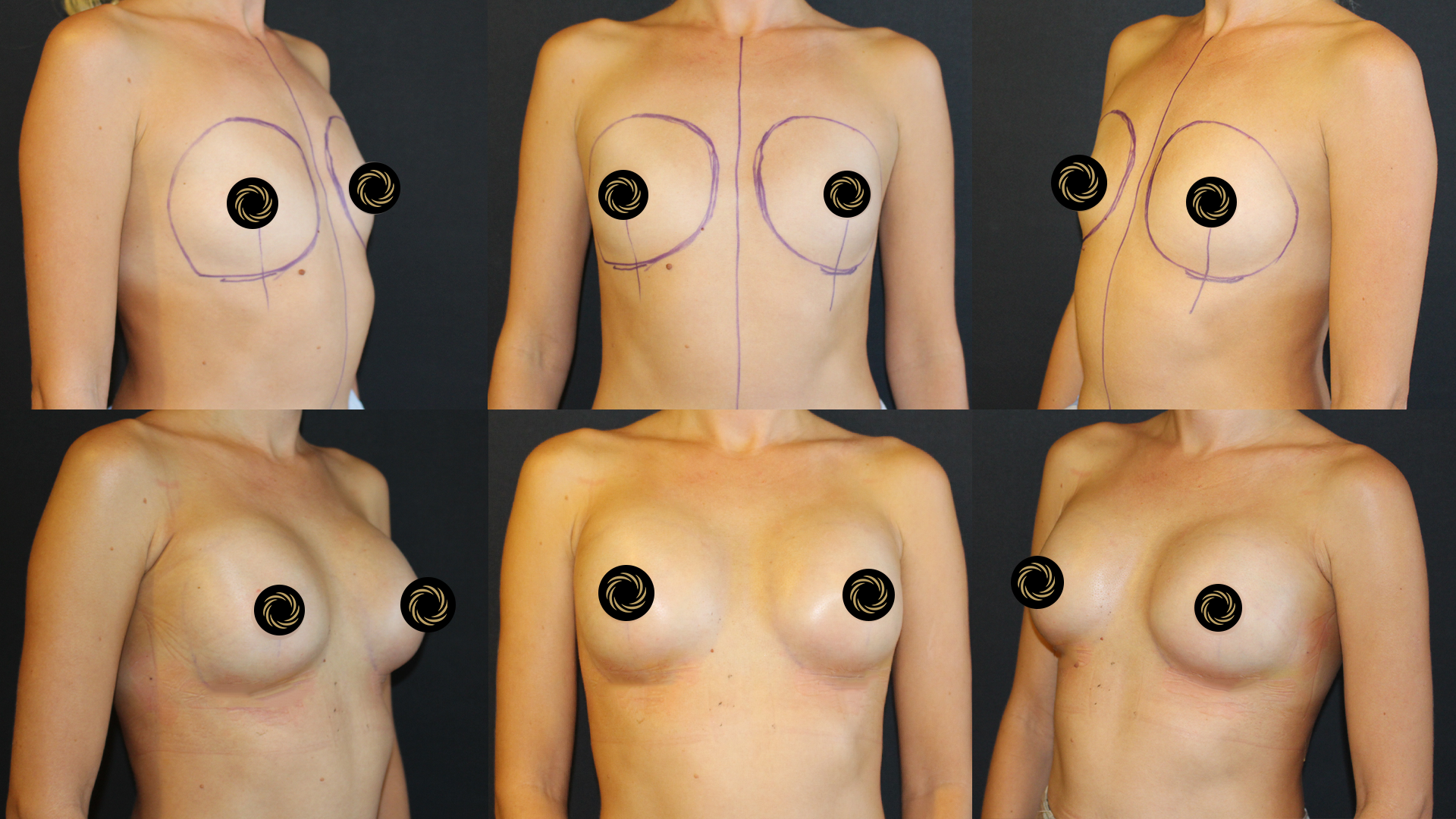 Breast Lift (Mastopexy) in Turkey breast-before-after3