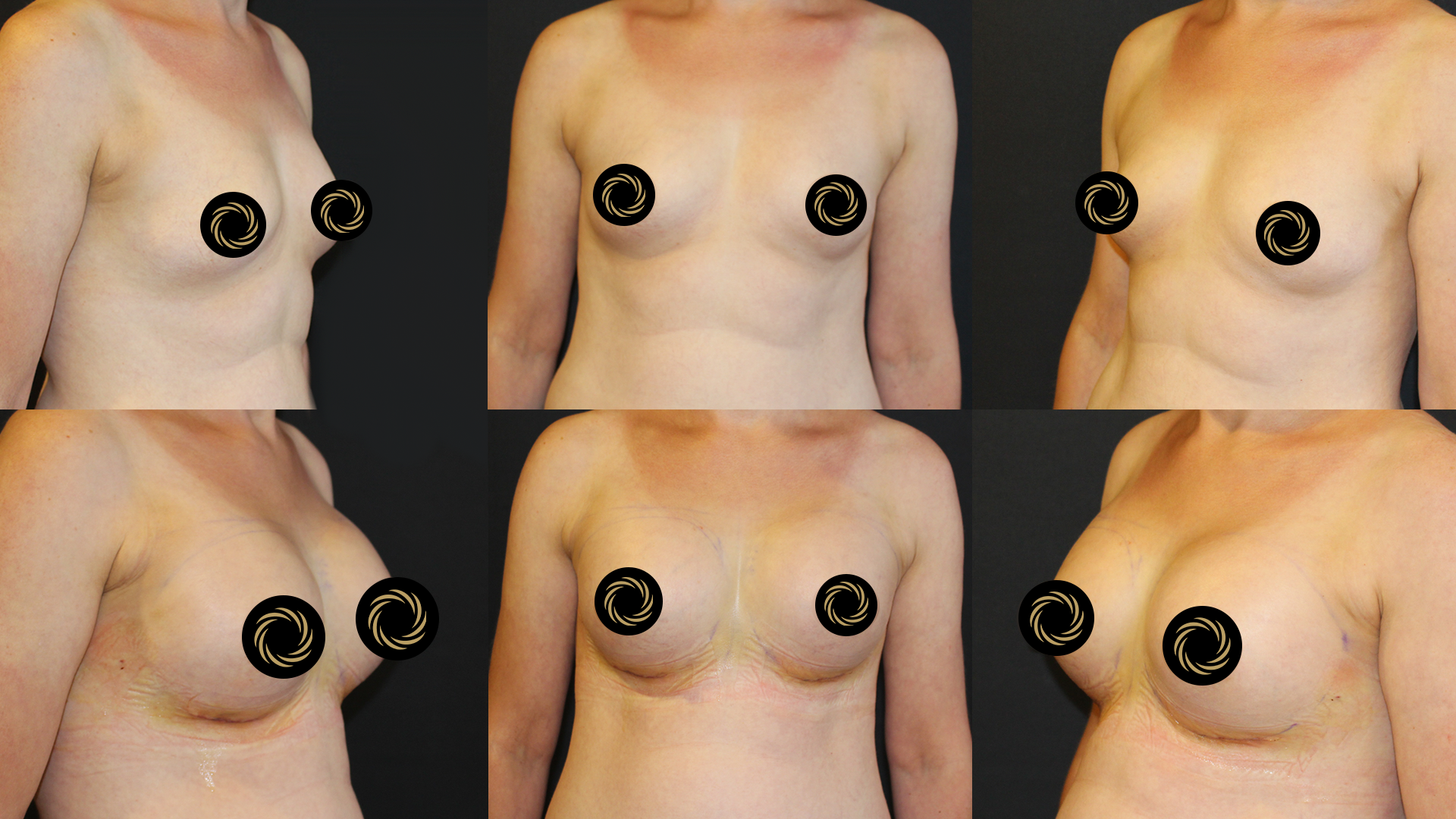 Breast Lift (Mastopexy) in Turkey breast-before-after4