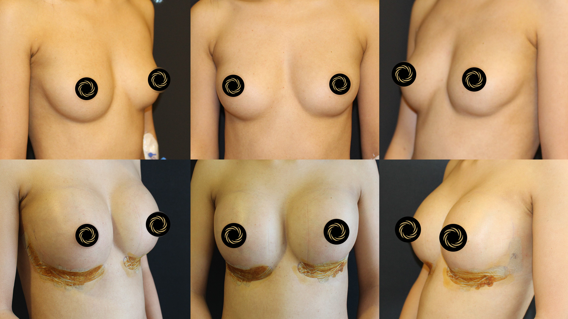 Breast Lift (Mastopexy) in Turkey breast-before-after8