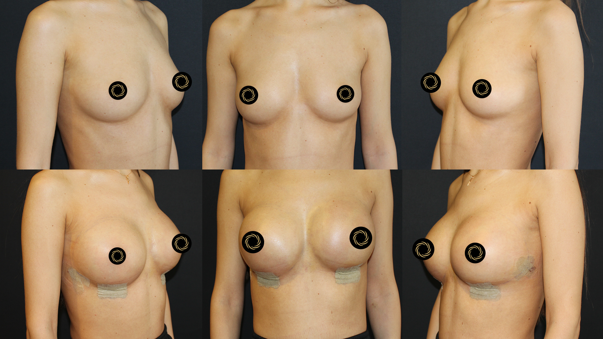 Breast Lift (Mastopexy) in Turkey breast-before-after9