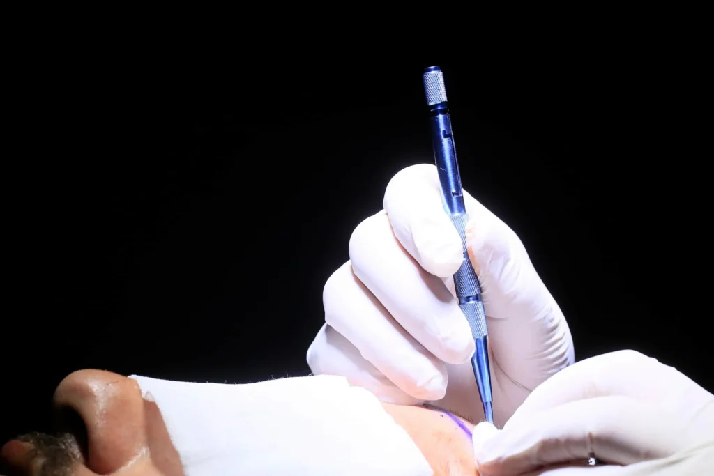 Hair Transplant