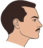 Hair Transplant in Turkey Hair Transplant in Turkey