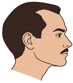 Hair Transplant in Turkey Hair Transplant in Turkey