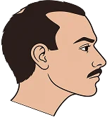 Hair Transplant in Turkey Hair Transplant in Turkey
