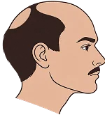 Hair Transplant in Turkey Hair Transplant in Turkey