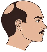 Hair Transplant in Turkey Hair Transplant in Turkey