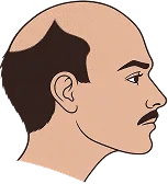 Hair Transplant in Turkey Hair Transplant in Turkey