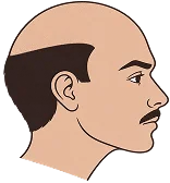 Hair Transplant in Turkey Hair Transplant in Turkey